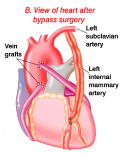 جراحی قلب