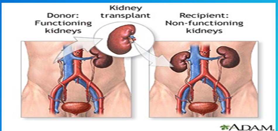 Kidney transplant